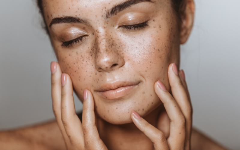 visage d'une femme avec tâches de rousseur